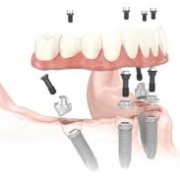 allon4, allonfour, all on 4, all on four, 4 implantátumra híd, Malo híd, pécs