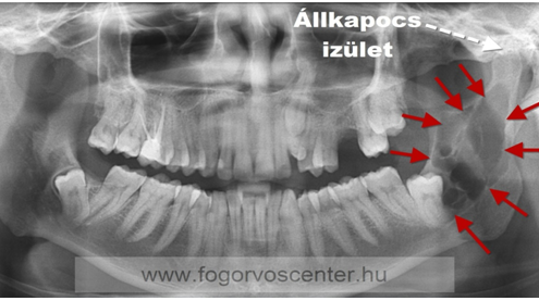 Beékelődött bölcsességfog okozta, az egész állkapocs felhágó ágát érintő ciszta