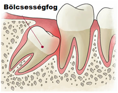 bolcsessegfog_gyulladas_pecs