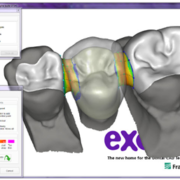 Inlay elhogonyzású híd CAD-CAM technológiával (híd csiszolás nélkül)