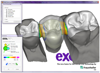 Inlay elhogonyzású híd CAD-CAM technológiával (híd csiszolás nélkül)