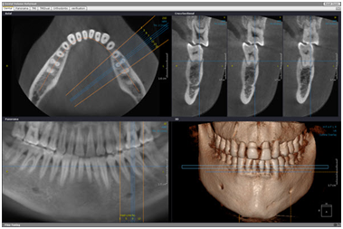 CT felvétel (CBCT)