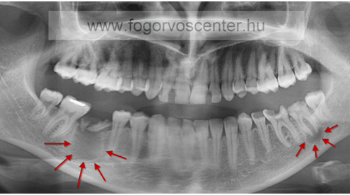Letört fogakból kialakult gennyes tályog illetve ciszta