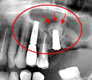 Arcüreg alap emelés („sinus lift”) és csontpótlás fogbeültetés előtt