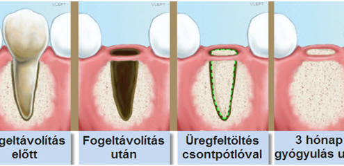 Fogeltávolítás után azonnali csontpótlás