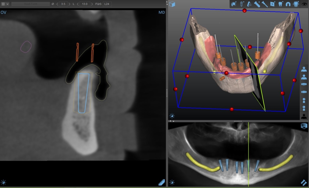 3D-s tervezés követően felhasznált műtéti sablon rendelőnkben (fogatlan alsó állcsont rehabilitációja 6 db implantátumon rögzített porcelán híddal)