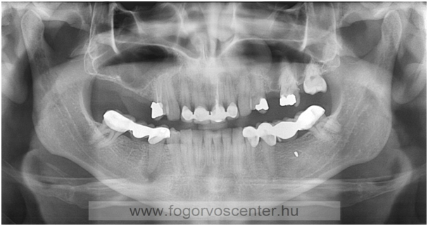 A komplex kezelési terv felállításához elengedhetetlen a panorámaröntgen