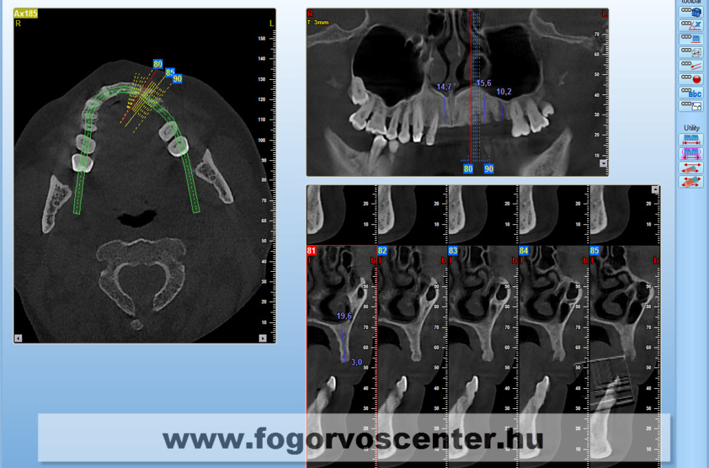 3D CBCT képelemző szoftver működése praxisunkban