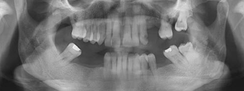 Előrehaladott fogágybetegség a fogkőleszedés rendszeres hiánya miatt (mozgó fogak)