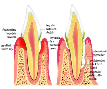 Fogkő okozta fogágybetegség kialakulása