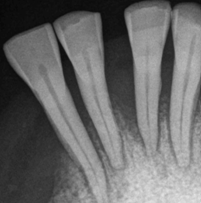 Előrehaladott fogágy betegség röntgenképe