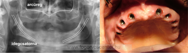 Elegendő csontmennyiség 8 fogimplantátum beültetéséhez, majd az erre készülő fix körhíd
