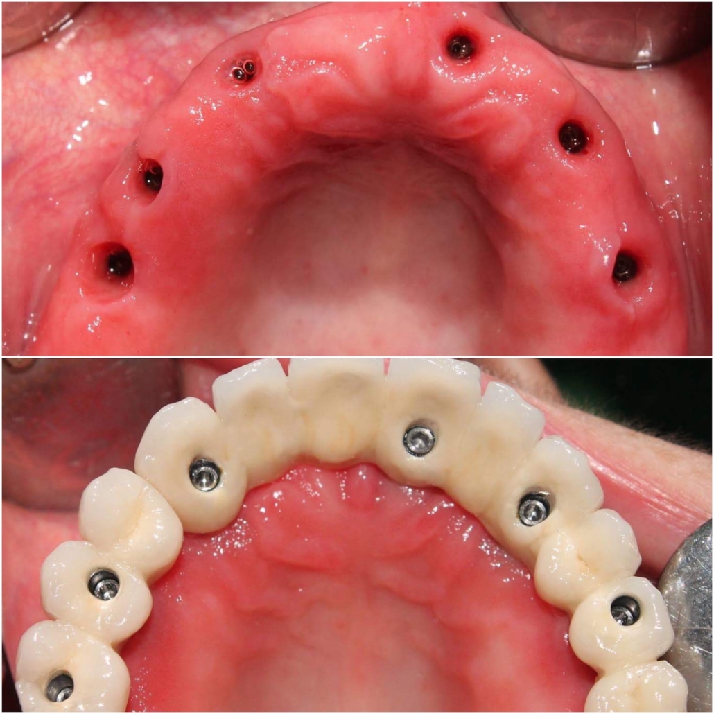 Összes fog hiánya esetén 6 implantátumra csavarozott, 12 tagú titán-kerámia híd