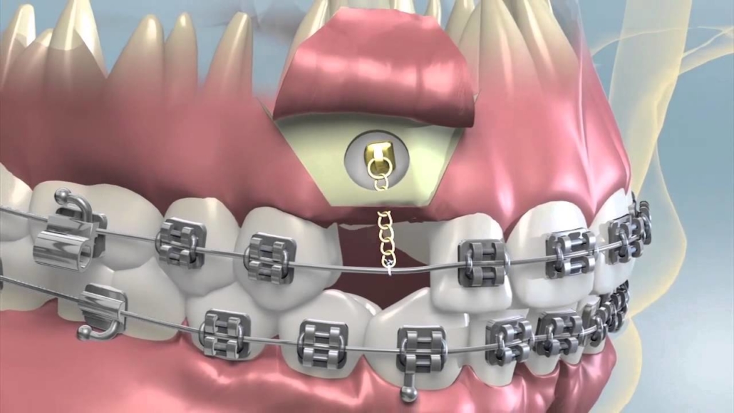 Felső állcsontba beékelődött szemfog ortodonciai (fogszabályozási) lehúzása rögzített fogszabályzóval és rugókkal