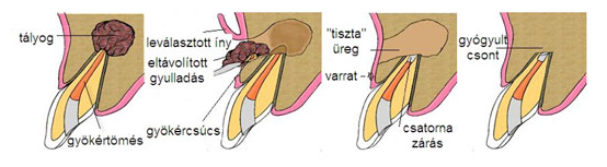 Gyökércsúcs rezekció (gyökércsúcs amputáció, foggyökér ciszta eltávolítás)