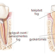 Porcelán koronával és gyökércsappal felépített gyökérkezelt fog