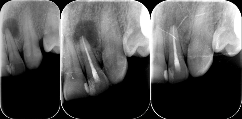 Rosszul záró, régi tömés miatt elhalt felső kismetsző és következményes tályogképződés gyökérkezelés előtt (balra), közvetlenül gyökértömés után (középen) és 3 hónappal később gyógyultan (jobbra)