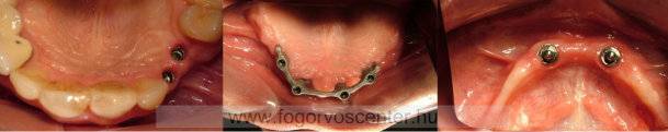 Felső szemfog és kisőrlő pótlása implantátumokkal csiszolás nélkül 5 tagú híd helyett (jobbra), felső stéges-implantációs fogsor 4 implantátumon (középen), alsó gömbretenciós-implantációs fogsor 2 implantátumon