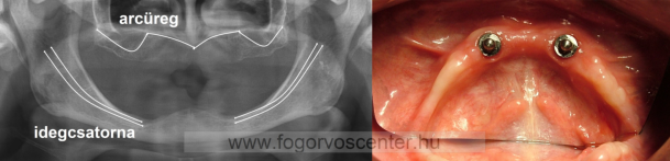 Alsó sorvadt állcsontba ültetett két implantátum és a rájuk készülő gömbretenciós („patentes”) fogsor a csontpótolt területen - lötyögő fogsor helyett stabilan ülő alsó fogsor!
