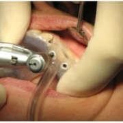 7 db implantátum beültetés implantációs sablonnal metszés nélkül!