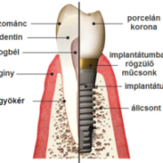 Csontba beültett implantátum és a rá készülő porcelán korona