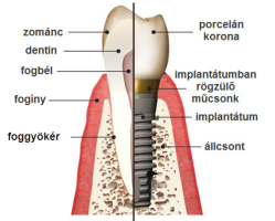 Csontba beültett implantátum és a rá készülő porcelán korona