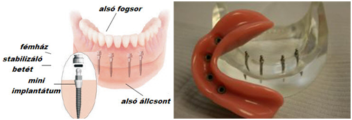 Beültetett mini implantátumokon stabilizált régi fogsor – a fogsor ragasztó a múlté!