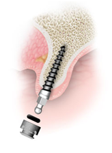 Mini implantátum a csontban és a fogsorba ragasztott rögzítő betét