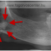 Nagyméretű (14 mm-es) nyálkő az állkapocs alatti nyálmirigy kivezetőcsövében