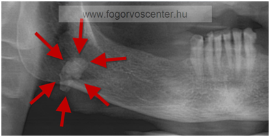 Nagyméretű (14 mm-es) nyálkő az állkapocs alatti nyálmirigy kivezetőcsövében