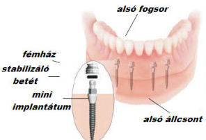 szép fogsor, tökéletes fogpótlás, kivehető fogsor, fogsor árak, gömbös fogpótlás, gömbretenciós protézis, implantációs fogsor, implantátumokon ülő protézis