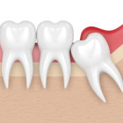 Bölcsességfogak szájsebészeti eltávolítása