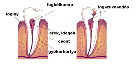 Fogszuvasodás